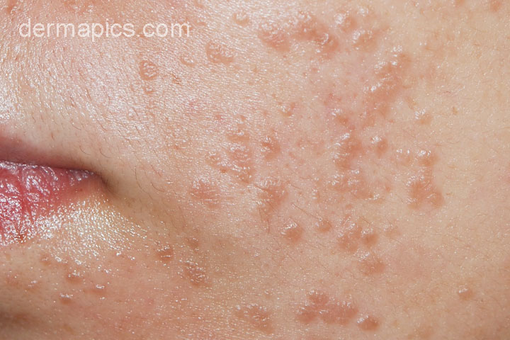 papillomavirus on face parazitologie fascioliasis
