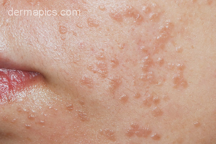 Organic facial for glowing skin - Facial warts hpv type Facial warts hpv type